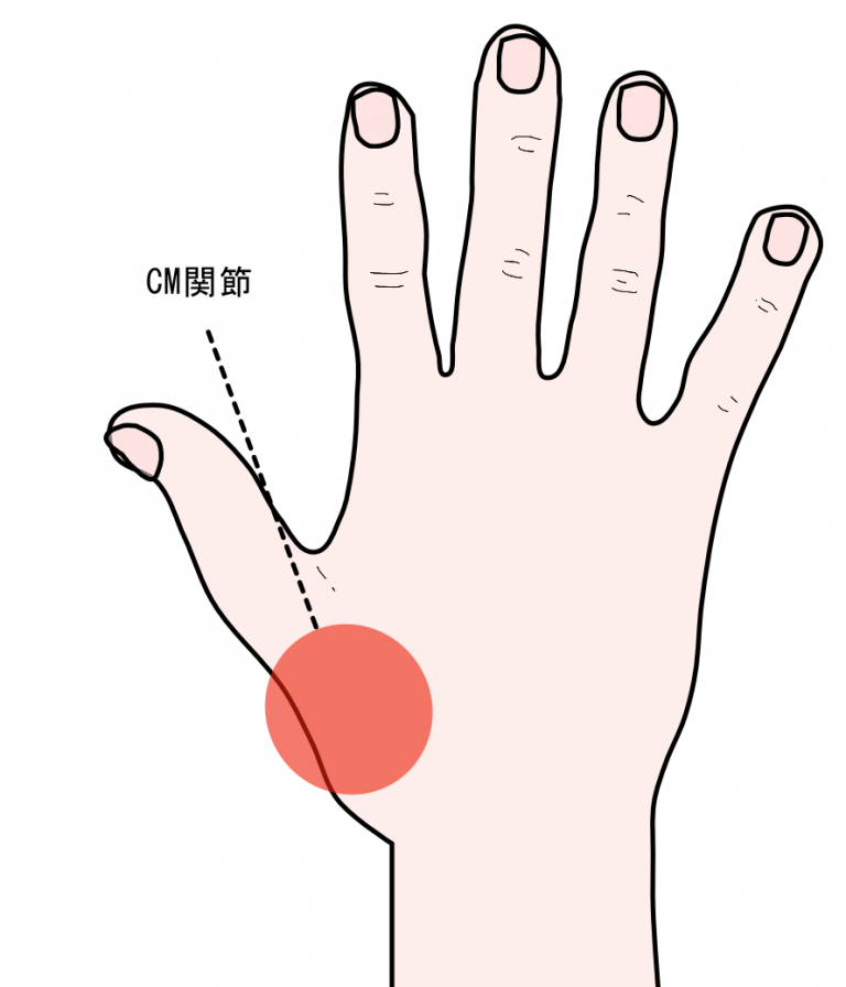手・手首の痛みでお困りの方へ : 井出整形外科クリニック