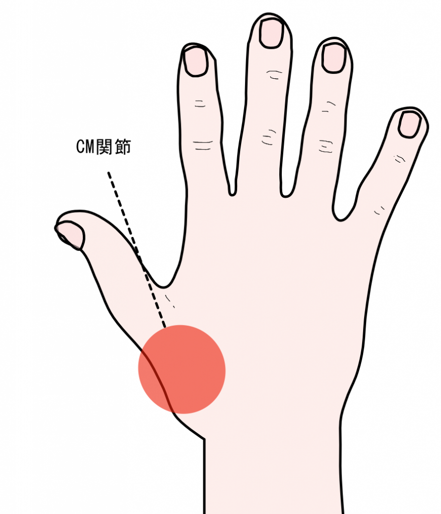 手の痛み　ＣＭ関節症