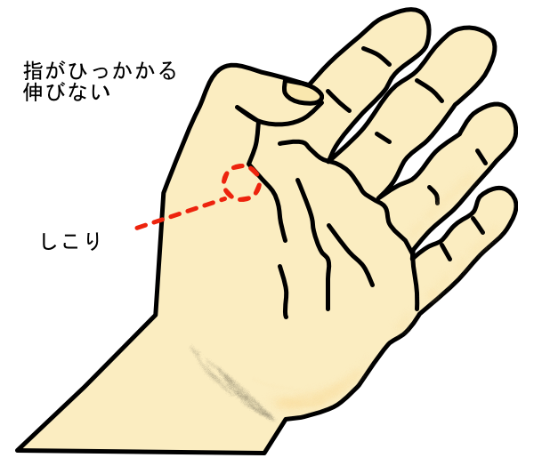 手の痛み　ばね指