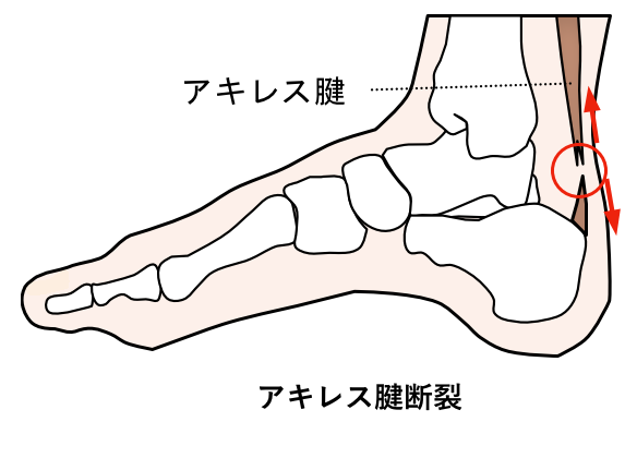 足首 足の痛みでお困りの方へ 井出整形外科内科クリニック