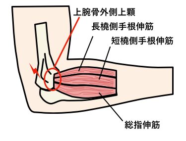 テニス肘の保存治療について : 井出整形外科クリニック