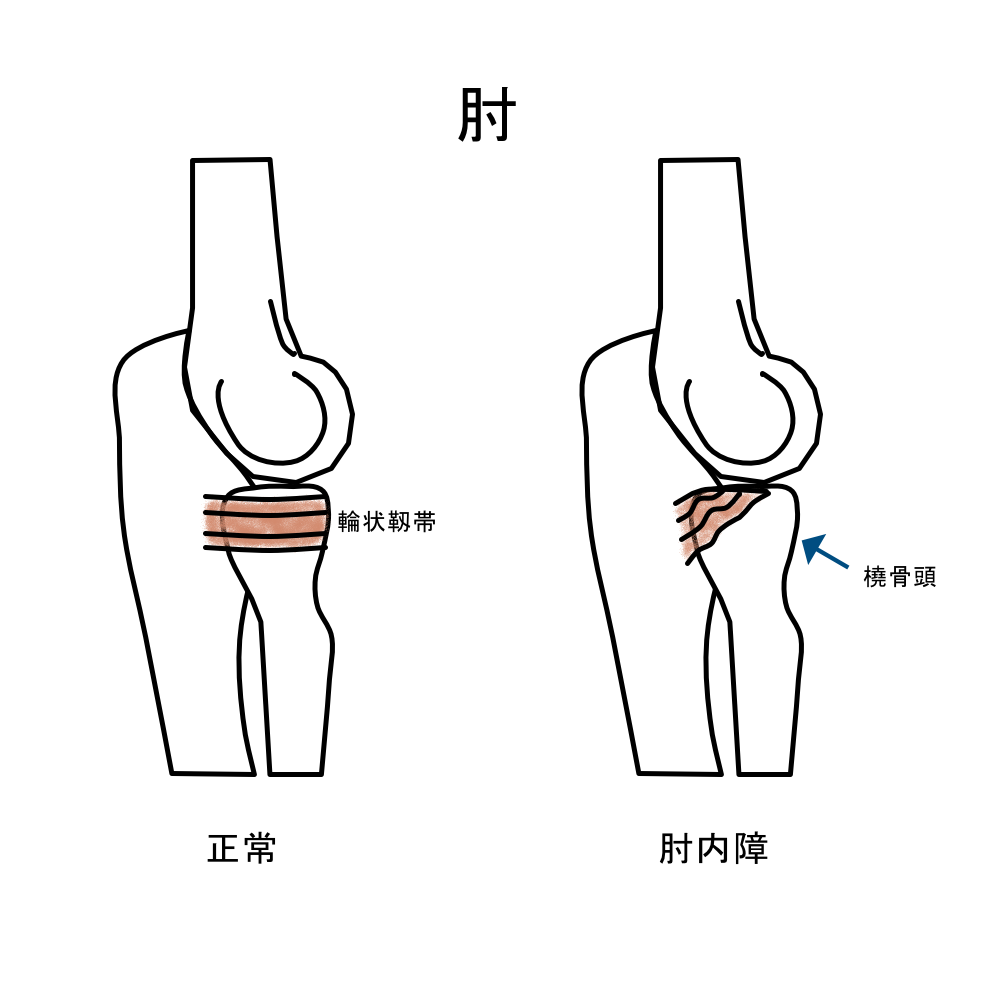 小児整形外科 井出整形外科内科クリニック 小児に特有の疾患 小児整形外科 井出整形外科内科クリニック 小児に特有の疾患