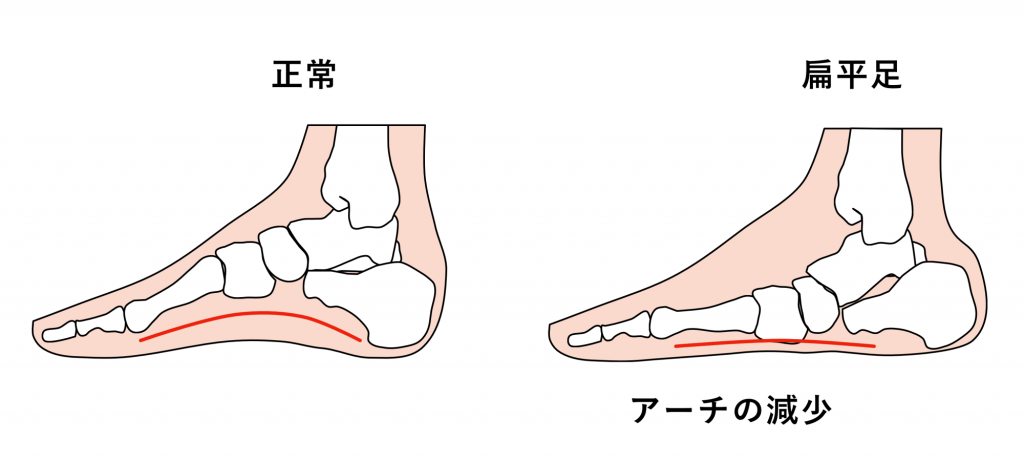 扁平足　足の痛み