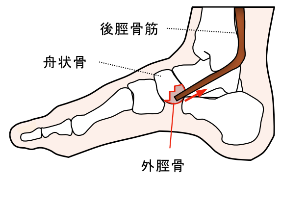 外脛骨　足の痛み