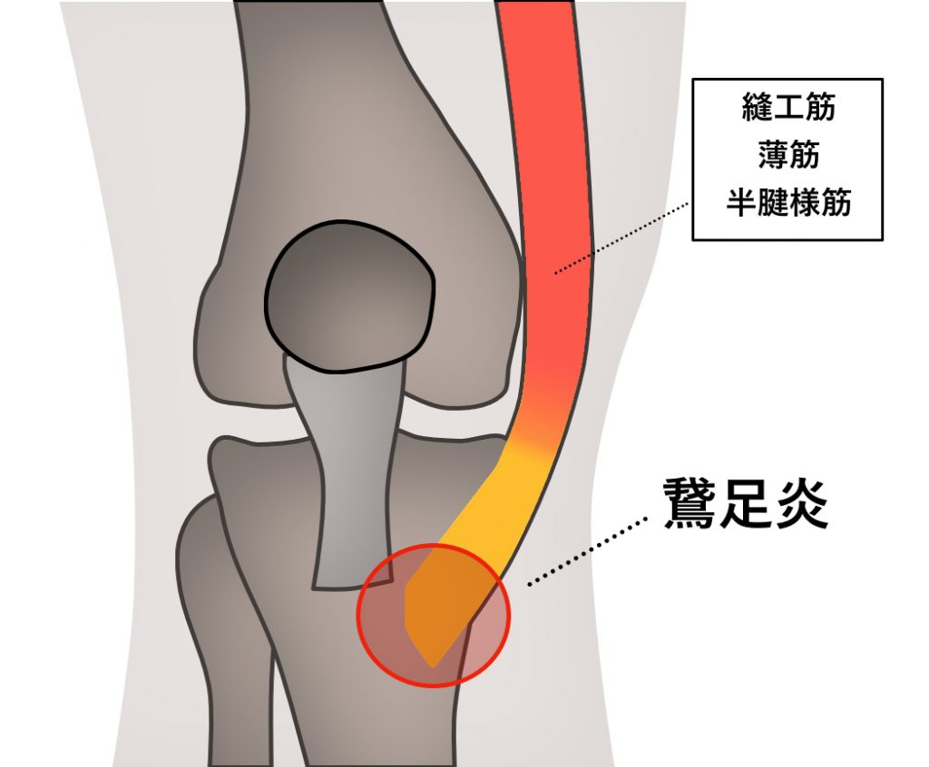 膝の痛みでお困りの方へ 井出整形外科内科クリニック