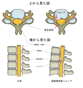 頚椎椎間板ヘルニア